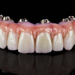 All on 4 Implants: The Truth They Don’t Tell You