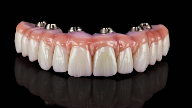 All on 4 Implants: The Truth They Don’t Tell You